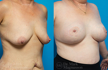 Breast Augmentation Mastopexy Gallery - 12