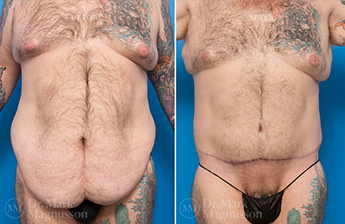 Male Bodylift - Obese - 1