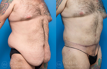 Male Bodylift - Obese - 2