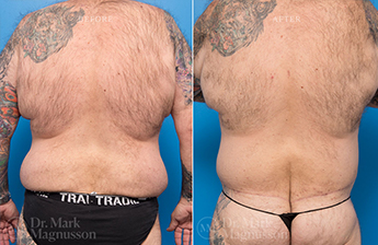 Male Bodylift - Obese - 3