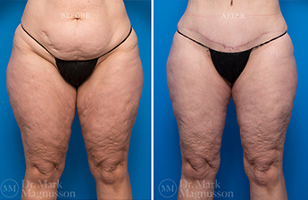 Thigh Reduction – Overweight - 1