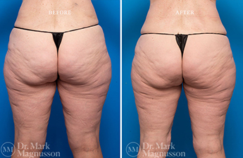 Thigh Reduction – Overweight - 2