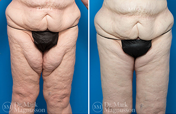 Thigh Reduction – Overweight - 3
