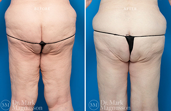 Thigh Reduction – Overweight - 4