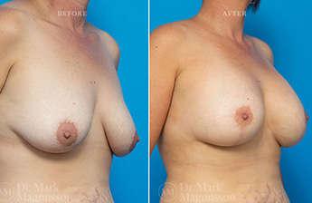 Augmentation Mastopexy - Normal - 24