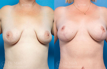 Augmentation Mastopexy - Obese - 1