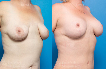 Augmentation Mastopexy - Obese - 2