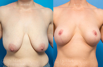 Augmentation Mastopexy - Over Weight - 3