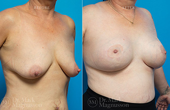 Augmentation Mastopexy - Over Weight - 9