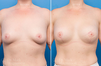 Augmentation Mastopexy - Over Weight - 16