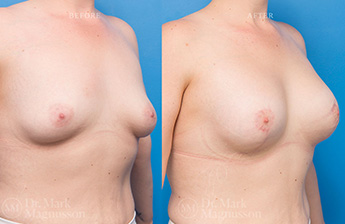 Augmentation Mastopexy - Over Weight - 17