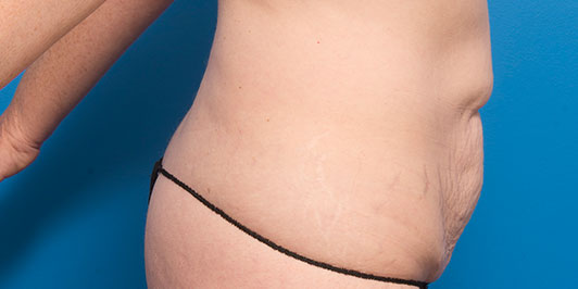 Post-pregnancy surgery galleries, model 2, Dr Magnusson, Toowoomba & Gold Coast