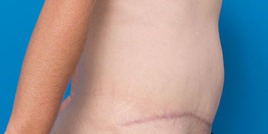 Abdominoplasty Hernia, before and after gallery, patient 1 before the surgery, Dr Magnusson 