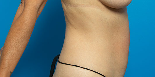 Mini Abdominoplasty Breast Augmentation, before and after gallery, Dr Magnusson