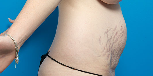 POstpartum surgery gallery 3, model image (before), Dr Magnusson