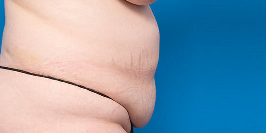 Abdominoplasty Bilateral Breast Reduction-Obese, before and after gallery, patient before surgery, Dr Magnusson