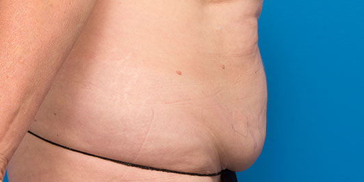 Abdominoplasty Bilateral Breast Reduction-Overweight, before and after gallery, patient before the procedure, Dr Magnusson