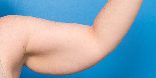 Arm Reduction (normal weight), before and after gallery, Dr Mangusson Gold Coast & Toowoomba