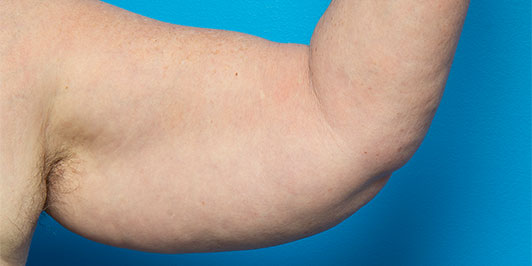 Arm Reduction (Obese), before and after gallery, Dr Mangusson