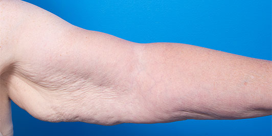 Arm Reduction (overweight), before and after, Dr Magnusson