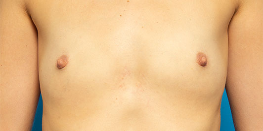 Breast augmentation gallery, before and afters, patient before procedure