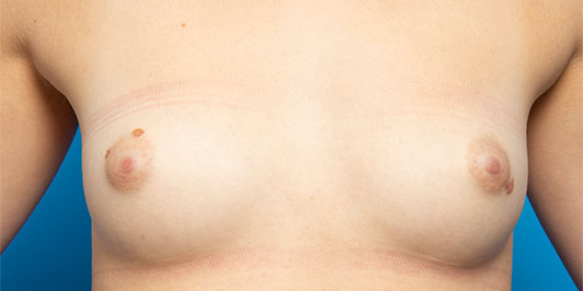 Asymmetry, breast augmentation galleries, Dr Magnusson, patient before the surgery