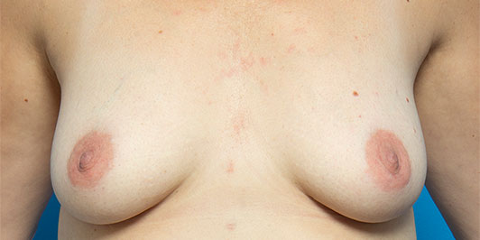 Low Nipple, breast augmentation galleries, Dr Magnusson