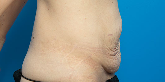 Postpartum surgery (combined), gallery 4, model image (before), Dr Magnusson