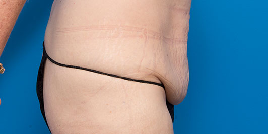 Body Lift (Normal Range), before and after gallery, Dr Magnusson