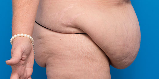 Body Lift (Obese), before and after gallery, Dr Magnusson