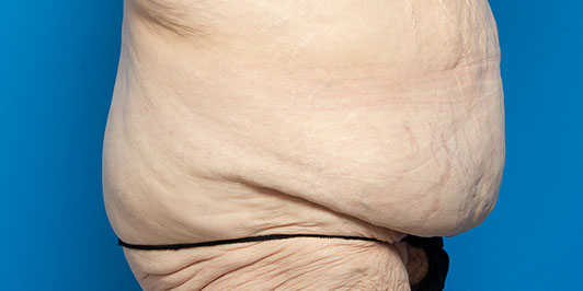 Body Lift (Overweight), before and after gallery, Dr Magnusson