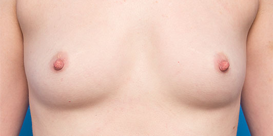 Breast fat grafting, before and after gallery, patient before surgery