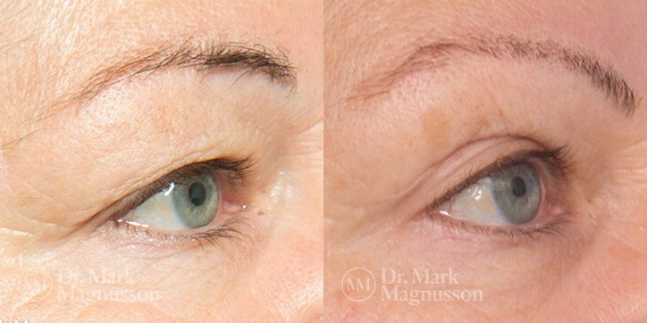 Brow_Lift__Eyelid_Surgery_2_new_