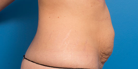 Liposuction (Normal Weight), before and after, Dr Magnusson