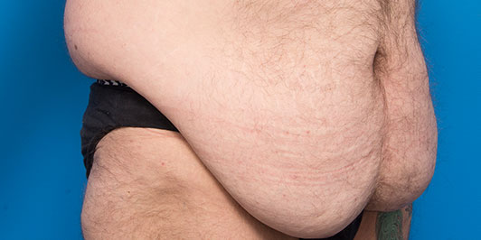 Surgery For Men - Male Body Lift, before and after gallery, model 1 (patient before surgery), Dr Magnusson