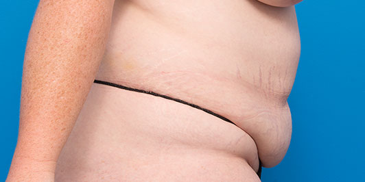 Massive Weight Loss-Obese, Postpartum surgery gallery, Dr Magnusson