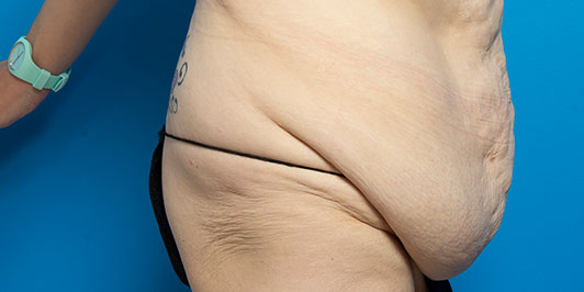 Massive Weight Loss-Overweight, Postpartum surgery galleries, Dr Magnusson