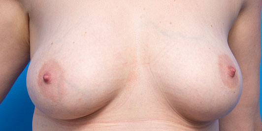 Breast lift surgery (Mastopexy), before and after gallery, patient before the surgery