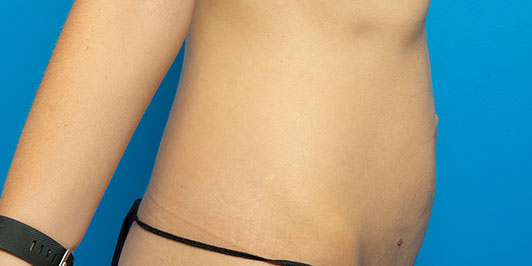 Mini Abdominoplasty, before and after, Gold Coast and Toowoomba Plastic Surgeon, Dr Magnusson