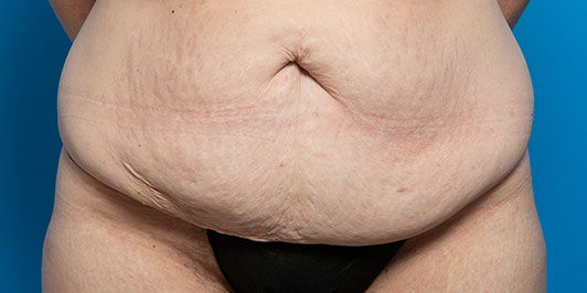 Significant Weight Loss-Abdominoplasty, before and after gallery, Dr Magnusson