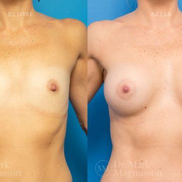 Breast Augmentation Mastopexy, before and after 05, anatomical shaped teardrop implants, front view, Dr Magnusson