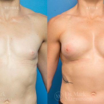 Breast Implants and Lift, anatomical shaped teardrop implants, before and after 09, Dr Magnusson