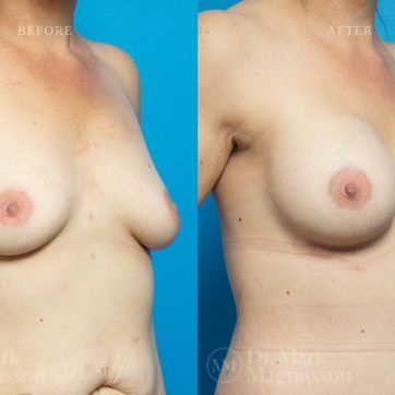 Breast Augmentation with Mastopexy (Breast Lift), anatomical shaped teardrop implants, before and after 12