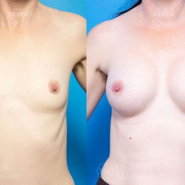 Augmentation Mammoplasty & Mastopexy (BAM), anatomical shaped teardrop implants, before and after 13