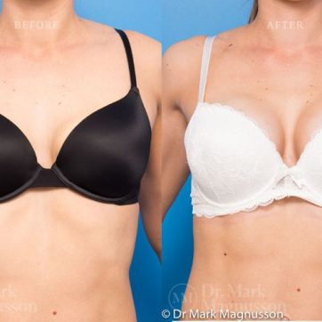 BAM-anatomical_shaped_teardrop_implants_019