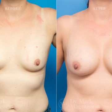 BAM-anatomical_shaped_teardrop_implants_021