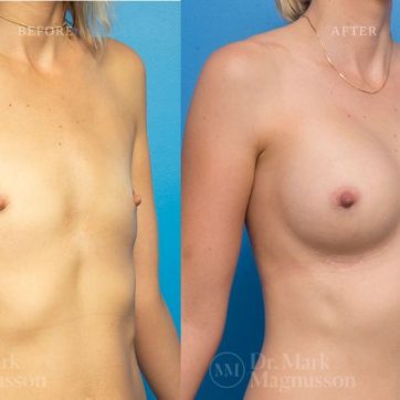 BAM-anatomical_shaped_teardrop_implants_024