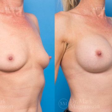 BAM-anatomical_shaped_teardrop_implants_030