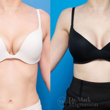 BAM-anatomical_shaped_teardrop_implants_034