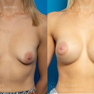 BAM-anatomical_shaped_teardrop_implants_036